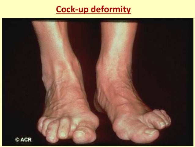 cock up toe deformity Linda henry nude